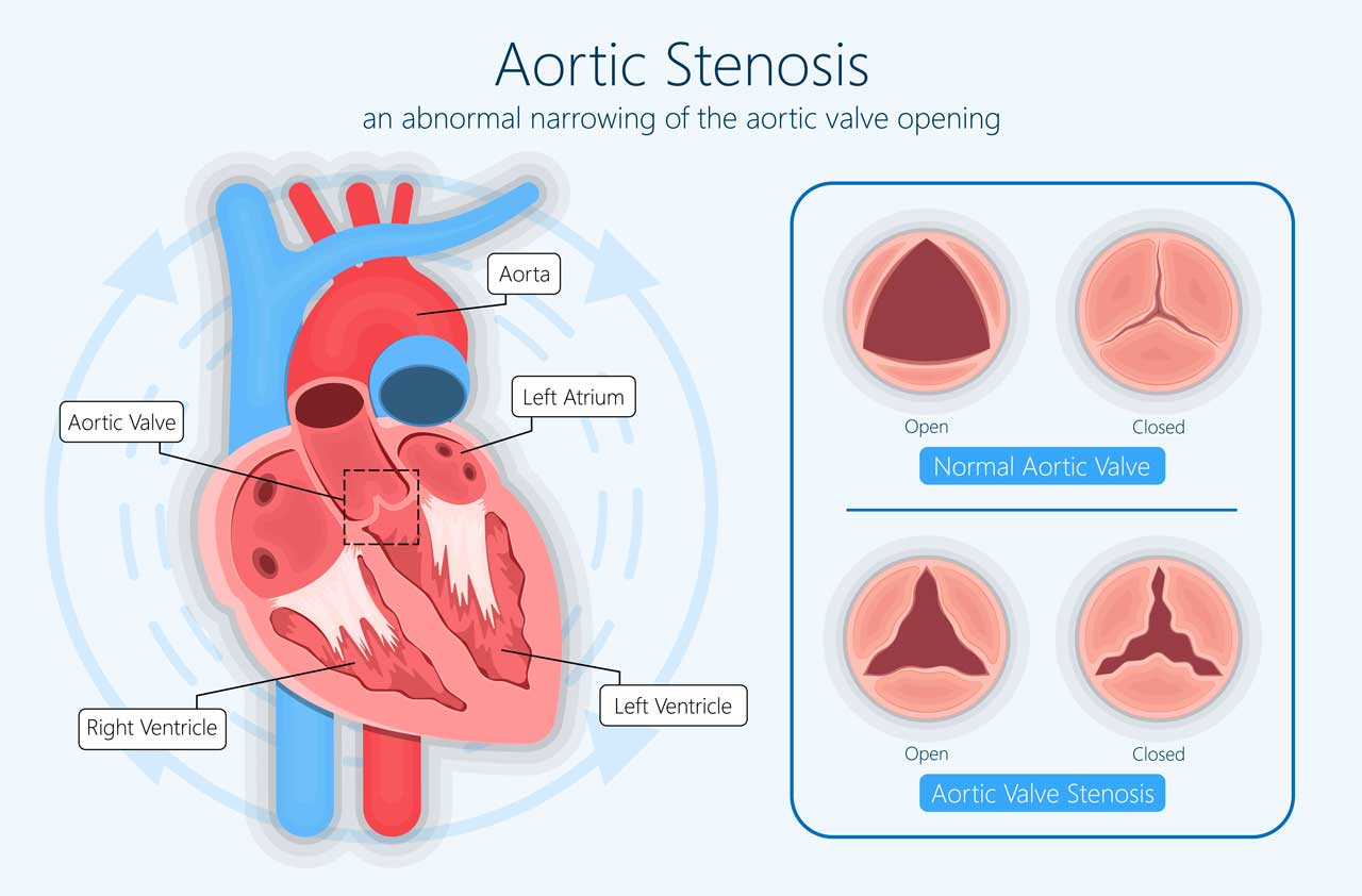 1280-aortic-imageshutter1582253137